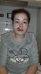 20-year-old Nicole Dwyer received a horrific injury as the result of a hatchet attack.